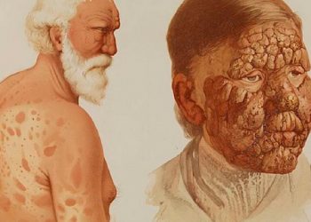 Kusta atau Leprosi: Penyakit Purba yang muncul kembali