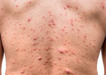 Remaja Antivaksin Saman Sekolah Tutup Akibat Chickenpox Mengidap Chickenpox
