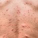 Remaja Antivaksin Saman Sekolah Tutup Akibat Chickenpox Mengidap Chickenpox