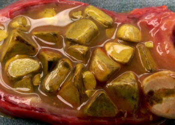 Batu Hempedu : Komplikasi & Rawatan