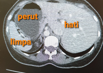 Beralih Hati : Situs Inversus