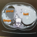 Beralih Hati : Situs Inversus