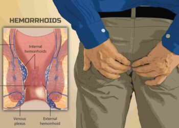 Najis Berdarah : Adakah Buasir?