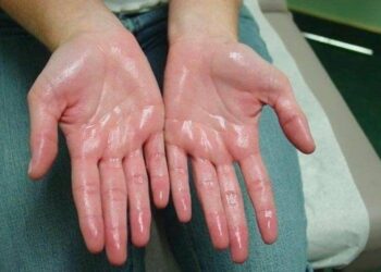 Hiperhidrosis, Gejala Peluh Berlebihan: Bolehkah dirawat?