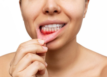 Peranan Vitamin D untuk Kesihatan Gusi