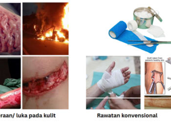 Kaedah Baharu membantu Penyembuhan Luka Kronik dengan lebih cepat