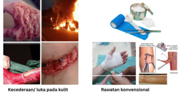 Kaedah Baharu membantu Penyembuhan Luka Kronik dengan lebih cepat