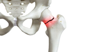 Retak Rapuh (fragility fracture): Ancaman Senyap Tulang Lemah