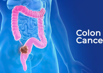Kanser Kolon: Realiti Tanpa Amaran