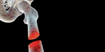 Inovasi Baharu Tulang Tiruan Menggunakan Teknologi Bioseramik Berkos Rendah