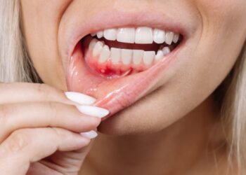 Gusi Berdarah Bukan Normal: Petanda Awal Penyakit Periodontal