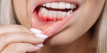 Gusi Berdarah Bukan Normal: Petanda Awal Penyakit Periodontal