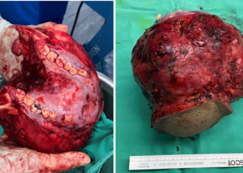 Ameloblastoma: Ketumbuhan yang Membawa kepada Kemusnahan Rahang
