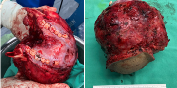 Ameloblastoma: Ketumbuhan yang Membawa kepada Kemusnahan Rahang