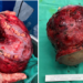 Ameloblastoma: Ketumbuhan yang Membawa kepada Kemusnahan Rahang