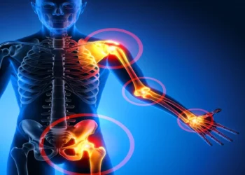 Penyakit Sistemik Lupus Eritematosus (SLE)