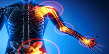 Penyakit Sistemik Lupus Eritematosus (SLE)