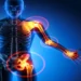 Penyakit Sistemik Lupus Eritematosus (SLE)